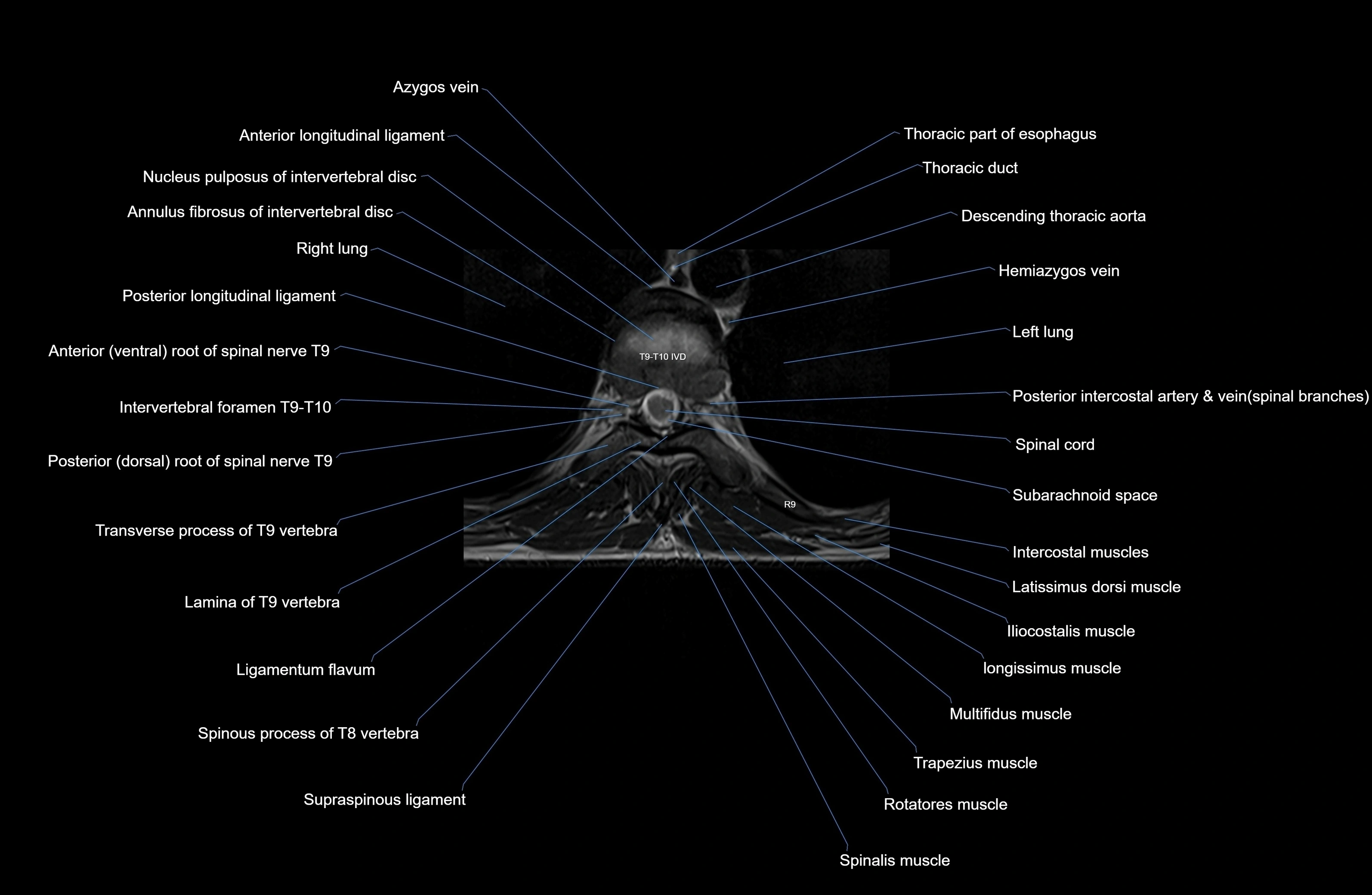 MRI thoracic spine axial  cross sectional anatomy 3T radiology  image-img-00001-00060.webp